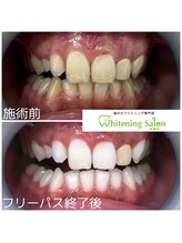 ホワイトニングサロン 札幌店/【ホワイトニング】#札幌#大通り