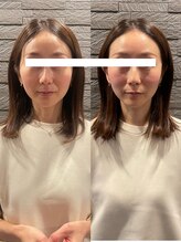 長寿鍼灸院 長寿整骨院/ハリネズミ女優美容鍼効果★