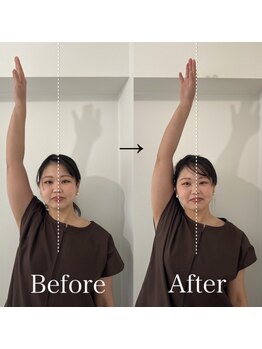 鍼グリッター 岡山本院(鍼Glitter.)/首肩の鍼灸施術