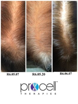 ヒルナム(Heal Nam)/プロセルセピーズ~頭皮~