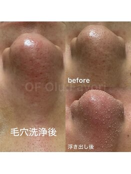 オフオルファヴォリ(OF Olu:Favori)/before after