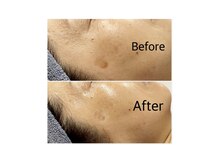 ミー(ME.)/６０代女性（シミ）