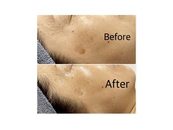 ミー(ME.)/６０代女性（シミ）