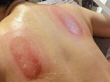 ひぺりかむ/《肩周り・脂肪冷却後》