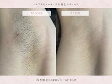 シエスタビューティラボ/【夏に向け】 ワキ脱毛