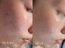 ウィハナ(wehana)/【毛穴洗浄×ララピール】毛穴