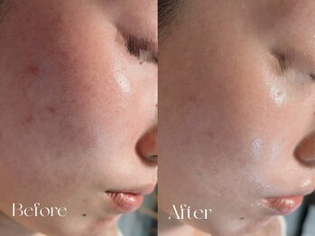 ウィハナ(wehana)/【毛穴洗浄×ララピール】毛穴