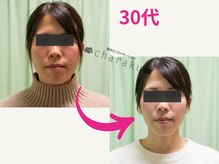 チャラク(charaku)/【30代N様：小顔矯正+光フォト】