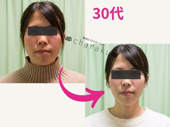 チャラク(charaku)/【30代N様:小顔矯正+光フォト】