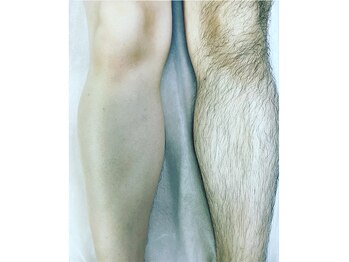 グラティアス(Gratias.)/足のWAX脱毛施術写真