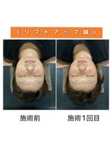 ワンドア(ONEDOOR)/【ビフォーアフター】リフトUP