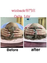 カラーリリー(Calla Lily)/頭蓋骨小顔矯正×winback