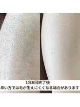 ビーボヌール(be-bonheur)/レディース全身脱毛