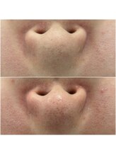 リアン(Lien)/毛穴洗浄で角栓除去♪