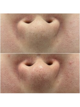 リアン(Lien)/毛穴洗浄で角栓除去♪