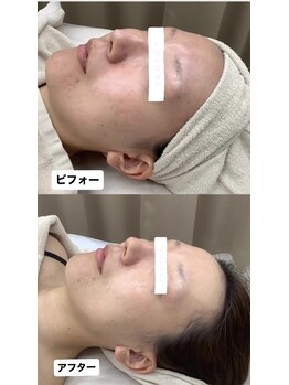 メリアミーゴ(Meli amigo)/30代 ハーブピーリング