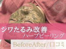 ベアール(beal)/艶美肌ハーブピーリング