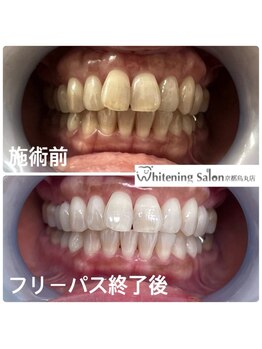ホワイトニングサロン 京都烏丸店/ホワイトニング施術例