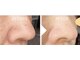 みんなの脱毛 ツルリン(TSURURIN)の写真/毛穴ケア！リンパに沿った水素による毛穴洗浄の後に2,200円の高級パックで引き締めながらヘッドスパ！！