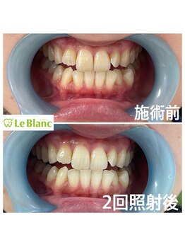 ルブラン 奈良店(Le Blanc)/黄ばみって気になりませんか?