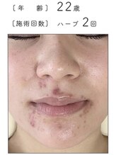 ノーブル 新宿南口(NOBLE)/ハーブピーリング専門新宿