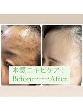 メリンダ(Merinda)/肌質改善