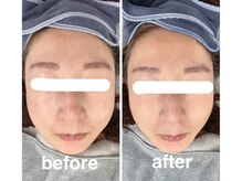 ハロ 南青山(HALO)/小顔リフト三層打ち3800shot