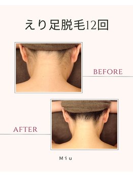 ミュウ(Miu.)/脱毛before/after