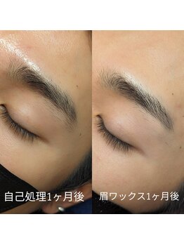 メンズオーシャンブルー/アイブロウ　症例