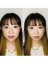 西宮しおりビューティーサロン(西宮しおりbeauty salon)/美容鍼 before(左)→after(右)１
