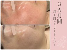 メシェリー(mecherie)の雰囲気（それぞれのお肌に合わせたケアでトラブルレスな肌を育てます）