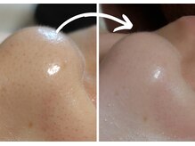 オスマンティエ(Osmantier)/毛穴洗浄ハイドロスプラッシュ