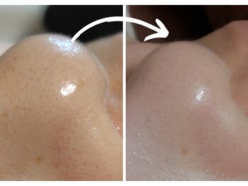 オスマンティエ(Osmantier)/毛穴洗浄ハイドロスプラッシュ