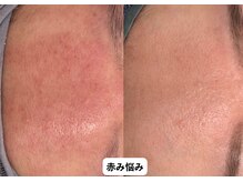 リメイク 銀座(REMAKE)/幹細胞ゴールドピーリング