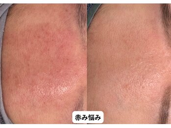 リメイク 銀座(REMAKE)/幹細胞ゴールドピーリング