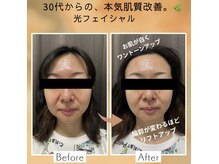 ルグナ(Lugna)の雰囲気(施術後はフェイスラインスッキリ!お肌ワントーンアップ♪)