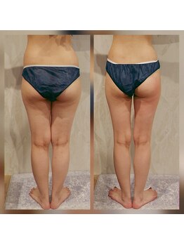 カルナボディ(Carna body.)/痩身エステで洋服の似合う脚に