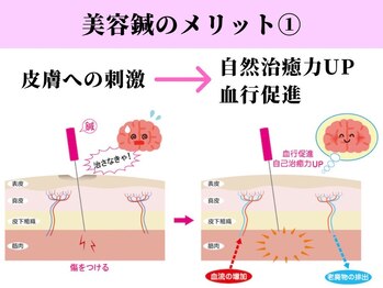 ビシンラボ(美SIN LAB)/美容鍼1：自然治癒力UP/血行促進