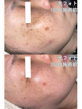 クレアナ ザ ビューティー(KULEANA the beauty)/光フォト