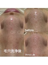 オフオルファヴォリ(OF Olu:Favori)/before after