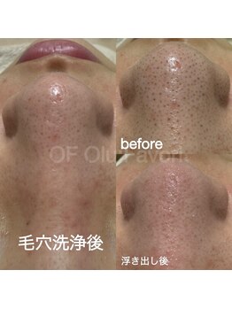 オフオルファヴォリ(OF Olu:Favori)/before after