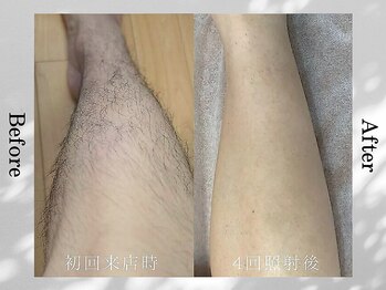 アンフルール(Une fleur)/脱毛 Before&After