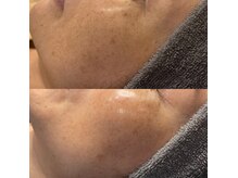 モルセラ(Moluccella)/12回の施術