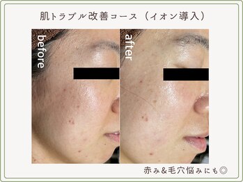 べセラ(BESERA)/肌トラブル改善コース