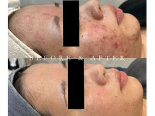 パリスヒロトン(PARIS HIROTON)の雰囲気（LDM白玉＆HAAB REPROはニキビでお悩みの方に最適）