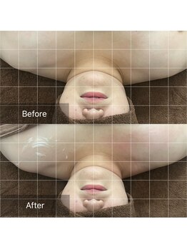 トニック バイ まつもと整骨院鍼灸院(Tonic)/★Before After★ 豊中/リンパ