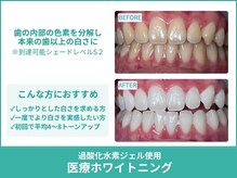 クレア(Crea)/【歯のホワイトニング症例写真】