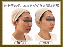 クリニカルエステ/イーズ パークプレイス大分店の雰囲気（施術直後に感動！dr'sメソ￥8800体験へ！）