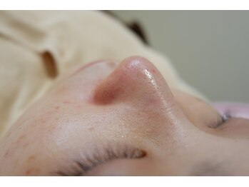 エヴァビーナス(EvaVenus)/毛穴ケア施術後♪