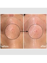 毛穴専科/ワックス脱毛メンズok/沖縄/那覇